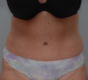 Abdominoplasty Before & After Patient #1496