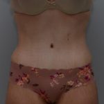 Abdominoplasty Before & After Patient #1495