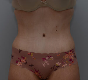 Abdominoplasty Before & After Patient #1495