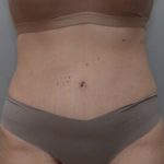Abdominoplasty Before & After Patient #1494