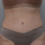 Abdominoplasty Before & After Patient #1494