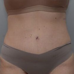 Abdominoplasty Before & After Patient #1494