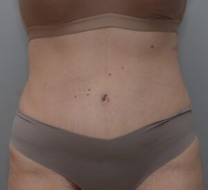 Abdominoplasty Before & After Patient #1494