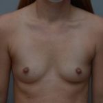 Breast Augmentation Before & After Patient #413