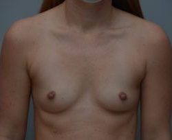 Breast Augmentation Before & After Patient #413