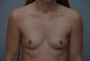 Breast Augmentation Before & After Patient #413