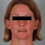 Facelift Before & After Patient #1743