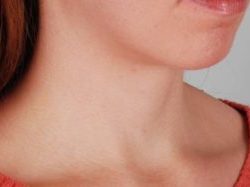 Neck Liposuction Before & After Patient #2005