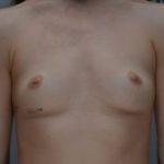 Breast Augmentation Before & After Patient #414