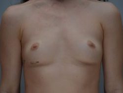 Breast Augmentation Before & After Patient #414