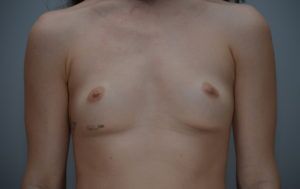 Breast Augmentation Before & After Patient #414