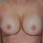 Breast Implant Exchange Before & After Patient #818