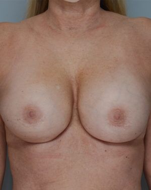 Breast Implant Exchange Before & After Patient #818