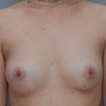 Breast Augmentation Before & After Patient #195