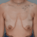 Breast Augmentation Before & After Patient #357