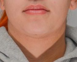 Neck Liposuction Before & After Patient #2006