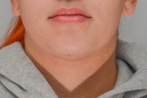 Neck Liposuction Before & After Patient #2006