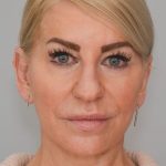 Facelift Before & After Patient #1745