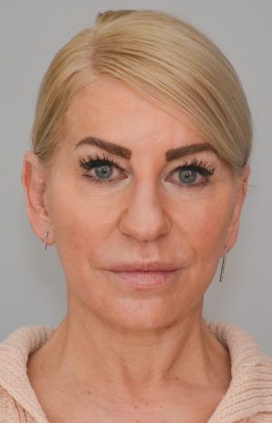 Facelift Before & After Patient #1745