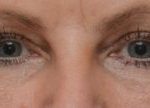 Blepharoplasty Before & After Patient #1704