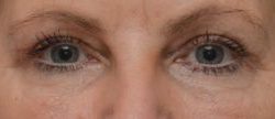 Blepharoplasty Before & After Patient #1704