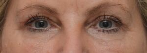 Blepharoplasty Before & After Patient #1704