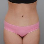 Abdominoplasty Before & After Patient #1271