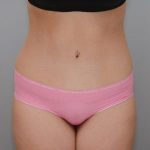 Abdominoplasty Before & After Patient #1643