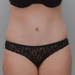 Abdominoplasty Before & After Patient #1387