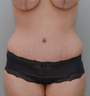 Abdominoplasty Before & After Patient #1440