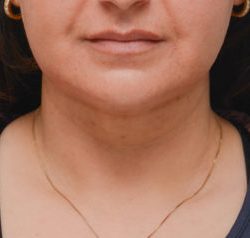Facetite Before & After Patient #1883