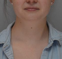 Neck Liposuction Before & After Patient #1952