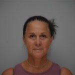 Facelift Before & After Patient #1744