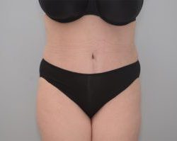 Abdominoplasty Before & After Patient #1210