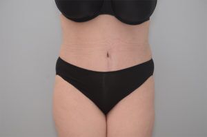 Abdominoplasty Before & After Patient #1210