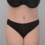 Abdominoplasty Before & After Patient #1589