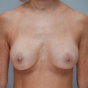 Breast Implant Exchange Before & After Patient #861