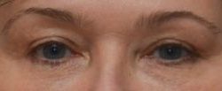 Blepharoplasty Before & After Patient #1703