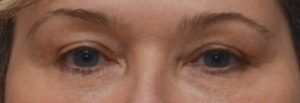 Blepharoplasty Before & After Patient #1703