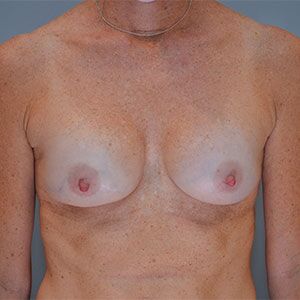 Breast Implant Exchange Before & After Patient #862