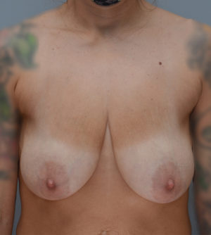 Breast Lift Before & After Patient #899