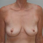 Breast Augmentation Before & After Patient #247
