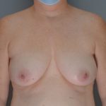 Breast Lift Before & After Patient #959