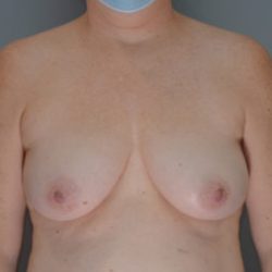 Breast Lift Before & After Patient #959