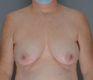 Breast Lift Before & After Patient #959