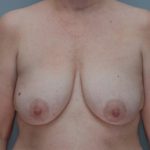 Breast Lift With Implants Before & After Patient #1094