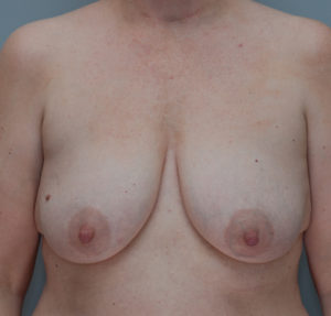 Breast Lift With Implants Before & After Patient #1094