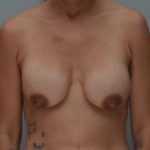Breast Lift With Implants Before & After Patient #1095