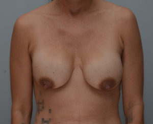 Breast Lift With Implants Before & After Patient #1095
