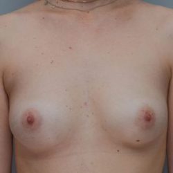 Breast Augmentation Before & After Patient #195